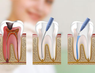 endodoncia